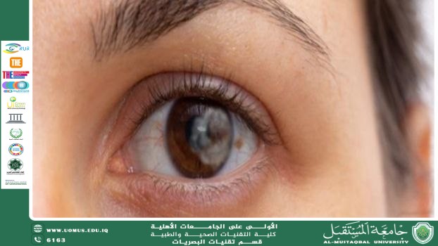 مقالة علمية للتدريسي م.م. مهيمن سمير عارف بعنوان (النقطة السوداء في العين).
