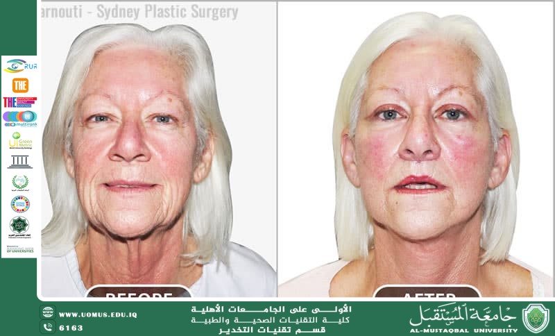 The Modern Facelift: A Comprehensive Guide to Rejuvenating Your Appearance