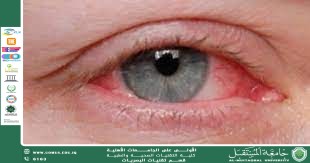 مقالة علمية للمعيدة فاطمة حيدر جاسم بعنوان (حساسية العيون في الصيف: الأسباب والوقاية والعلاج).