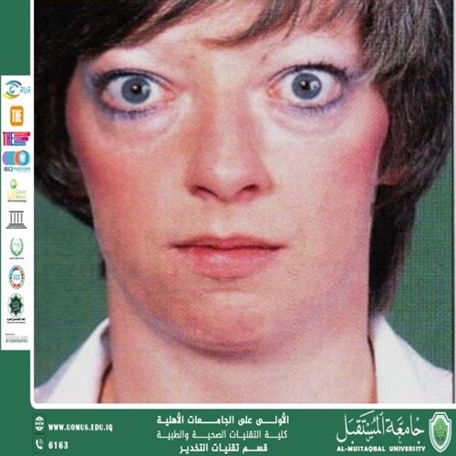 Graves disease مرض غريفز