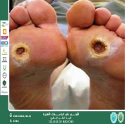 Understanding Diabetic Foot Disease: A Visual Guide for Prevention and Care
