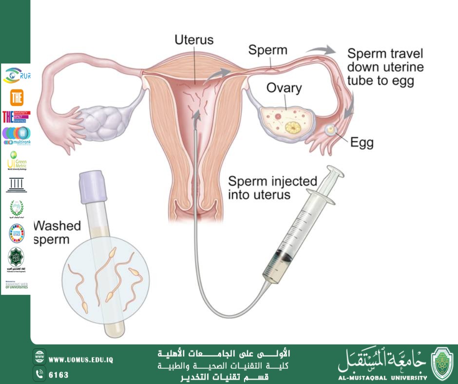 التلقيح الاصطناعي IUI : نظرة علمية موجزة
