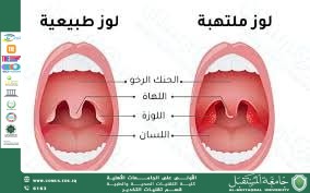 علاج التهاب اللوزتين عند الأطفال....