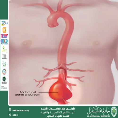 إصلاح تمدد الشريان الأبهر البطني: الخيارات الجراحية والتداخلية