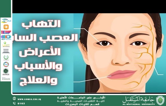 مقالة علمية للدكتور غيث علي محمود بعنوان(ما هو شلل العصب السابع:)