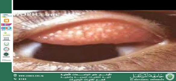 مقالة علمية لرئيس قسم تقنيات البصريات أ.م.د.منذر سمين شكر بعنوان(التراخوما )