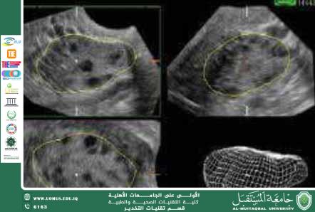 مقالة علمية وطبية عن التكيس وعلاجه المتطور