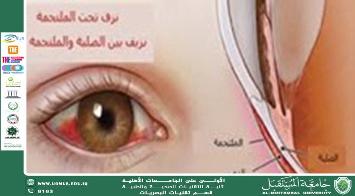 مقالة علمية للتدريسي م.م مروان هشام محمد بعنوان(النزف الدموي في ملتحمة العين)