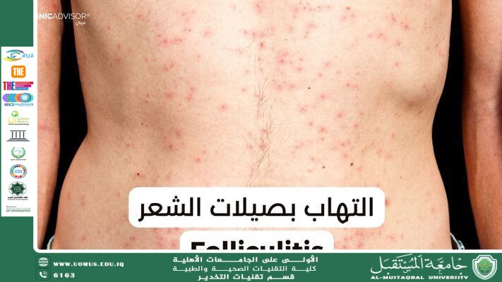 التهاب بصيلات الشعر  Folliculitis