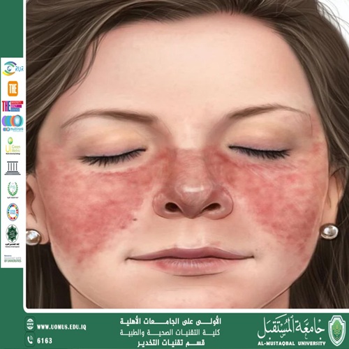  داء الذئبة الحمراء