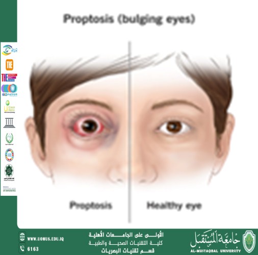 مقالة علمية للتدريسي م.م مروان هشام محمد بعنوان (جحوض العين).