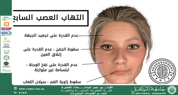 مقالة علمية للدكتور غيث علي محمود بعنوان (ما هو شلل العصب السابع).