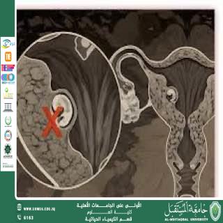 مقالة علمية للمعيدة ايلاف علي بعنوان الحمل الكيميائي (Chemical Pregnancy