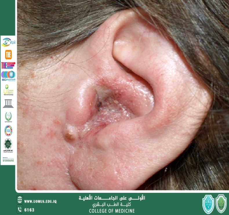 مقالة بعنوان التهاب الأذن الخارجية المزمن: الأسباب والعلاجات المتقدمة  