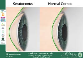 مقاله علمية للتدريسي دكتور غيث علي حمود بعنوان القرنية المخروطية  