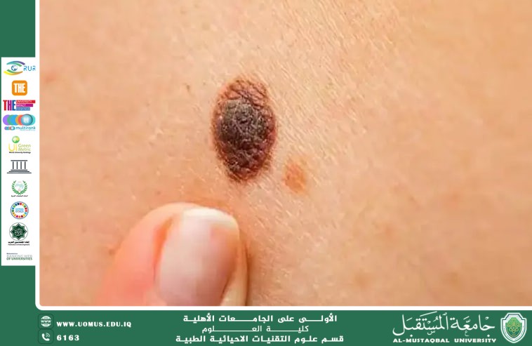 مقاله علمية (هبه صلاح هادي) بعنوان  "أسباب وأعراض وأنواع سرطان الجلد"