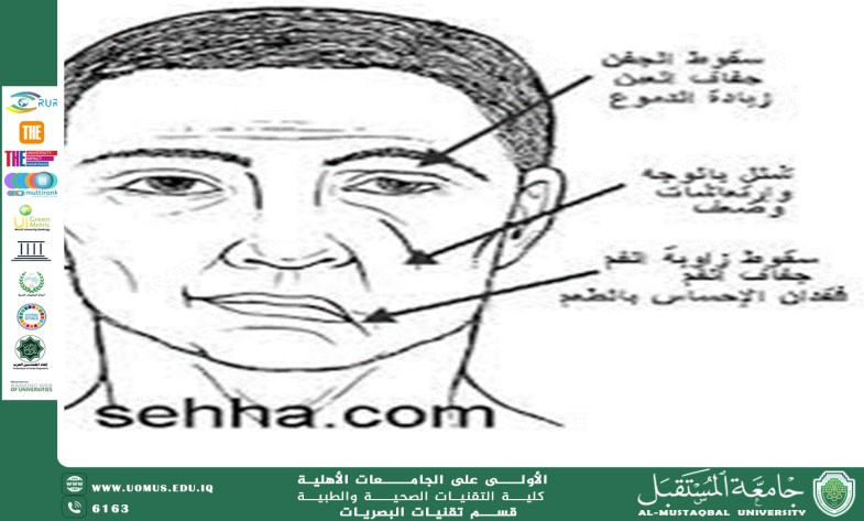 مقالة علمية للدكتور غيث علي محمود بعنوان (شلل العصب السابع).