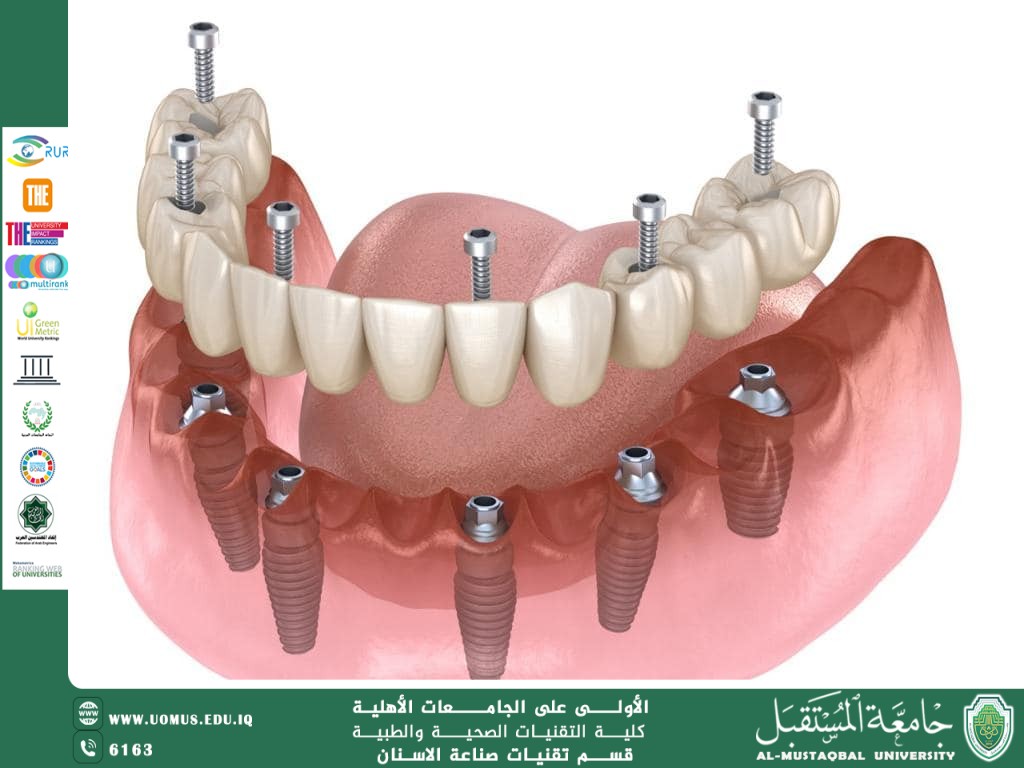 ✅ ما هي زراعة الأسنان؟