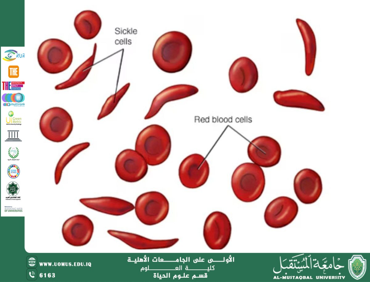 A scientific article by the teaching assistant, Ala Adel Rasmi, entitled "Sickle cell anemia "