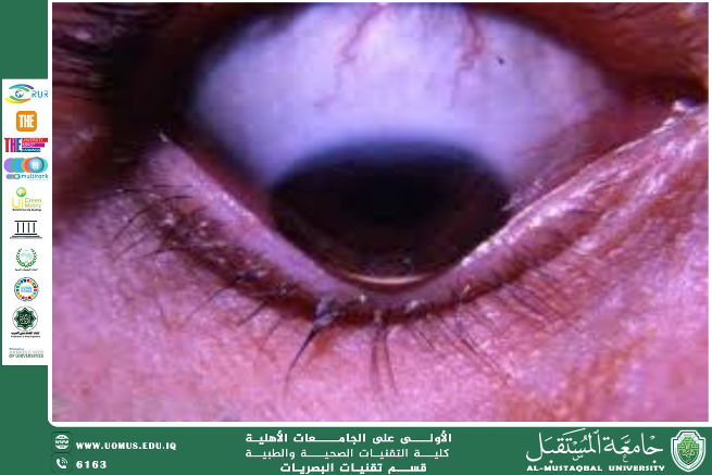 مقالة علمية للتدريسي الدكتور غيث علي محمود  (القرنية المخروطية 1)