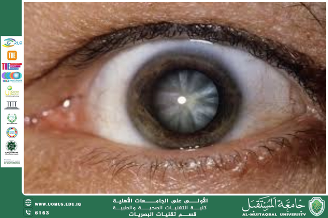 مقالة علمية للتدريسي م.م. علي هادي الحسيني (انعدام العدسة)