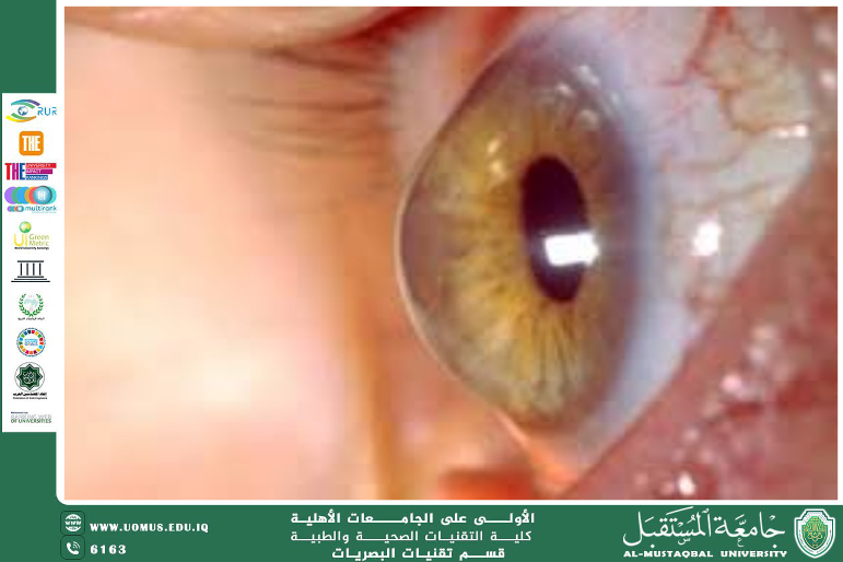 مقالة علمية للتدريسي م.م. مروان هشام محمد (اهمية قياس سمك القرنية لمرضى ضغظ العين)