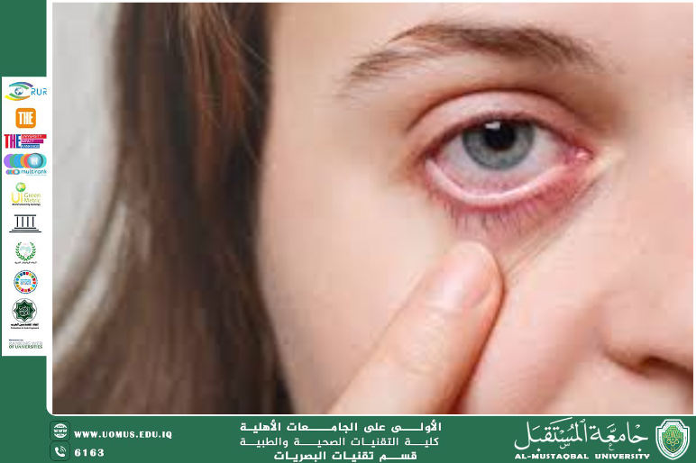 مقالة علمية للتدريسي م.م. علي هادي الحسيني (جفاف العين)