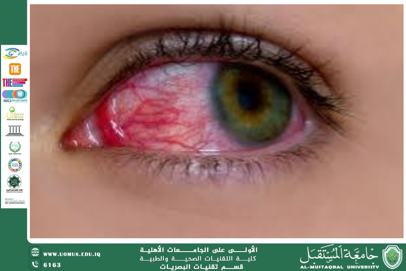 مقالة علمية للتدريسي م.م حسن قحطان كاظم الحسين  (تأثير التهاب الغدد اللمفاوية على العين: نظرة سريرية شاملة)