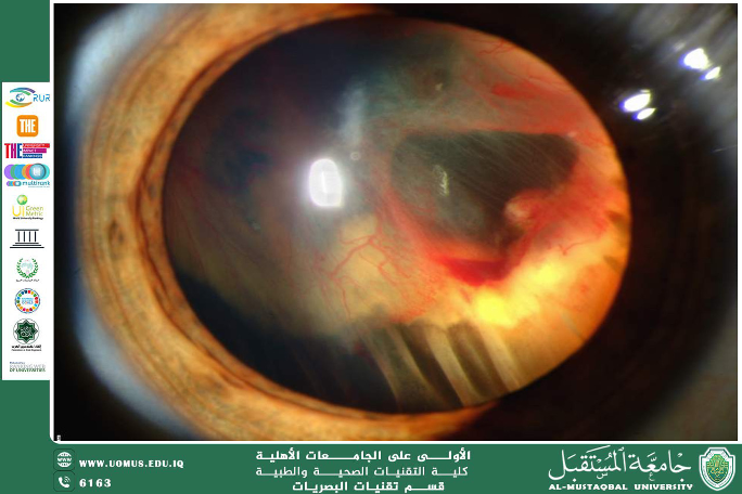 مقالة علمية للتدريسي م.م. علي هادي الحسيني (انفصال الشبكية)