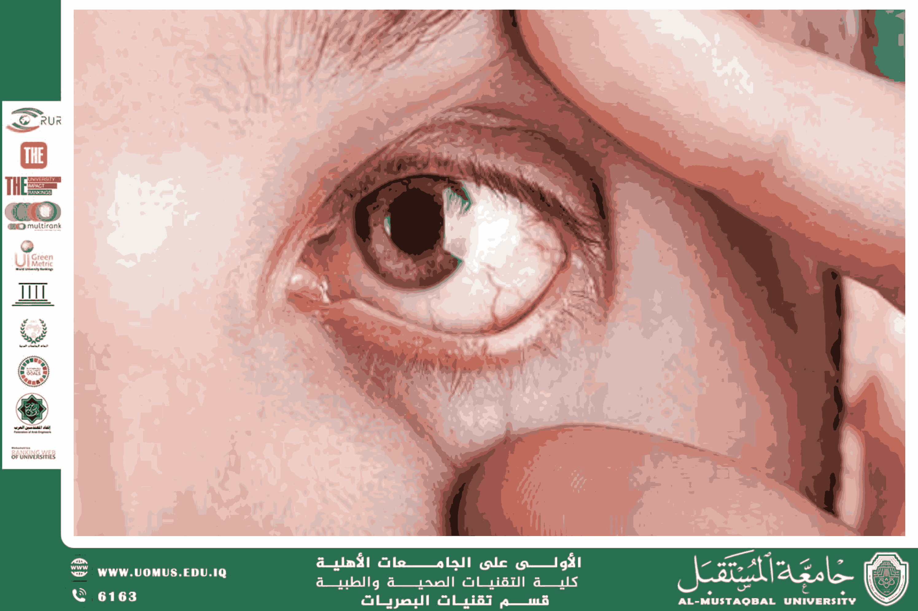 مقالة علمية للتدريسي م.م. علي هادي الحسيني (التغيرات المجهرية في القرنية ودورها في تشخيص الأمراض الجهازية)