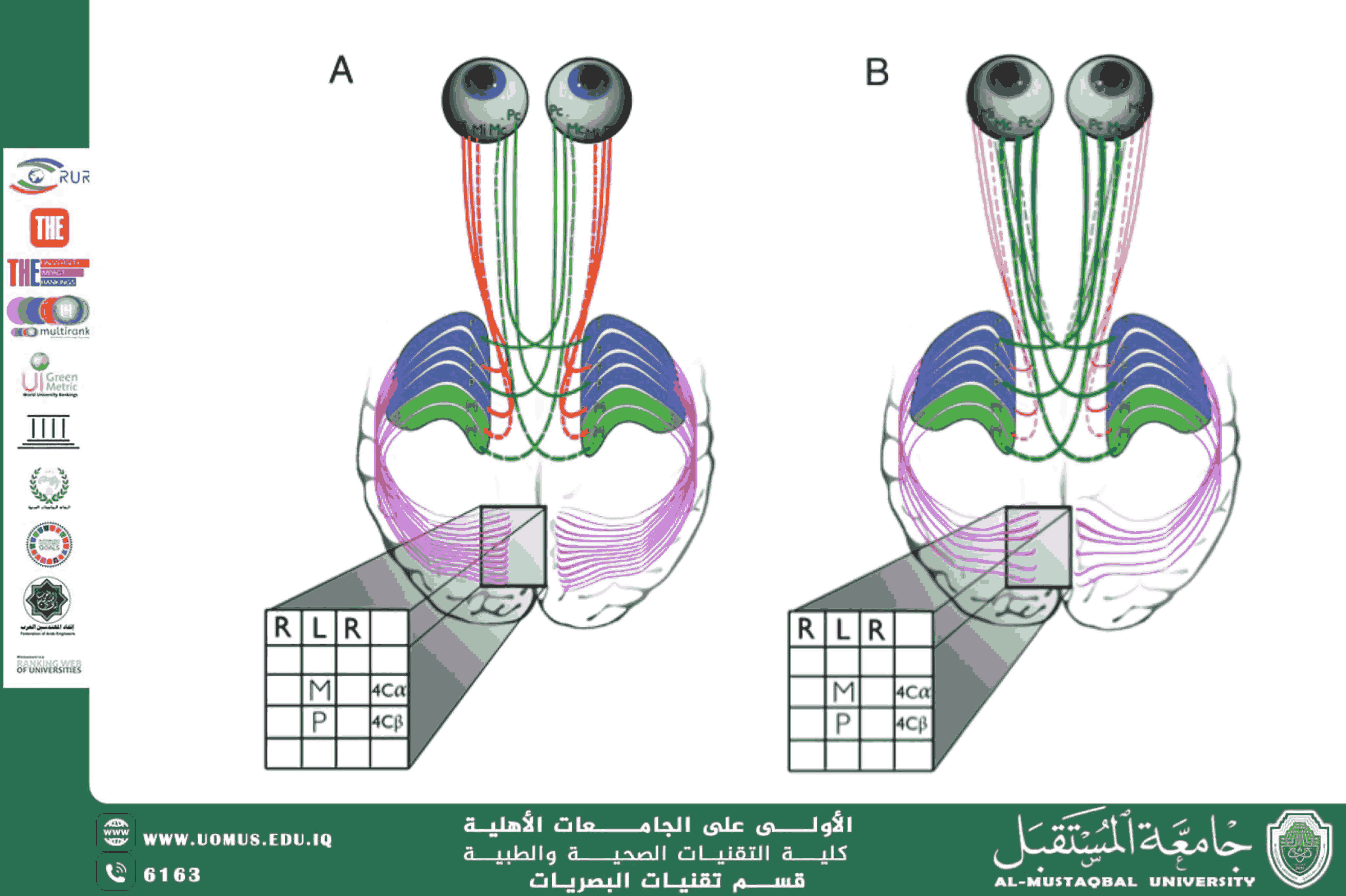 مقالة علمية للتدريسي م.م. مهيمن سمير عارف (اللدونة العصبية للقشرة البصرية في حالات الحول وكسل العين: آفاق جديدة للعلاج)