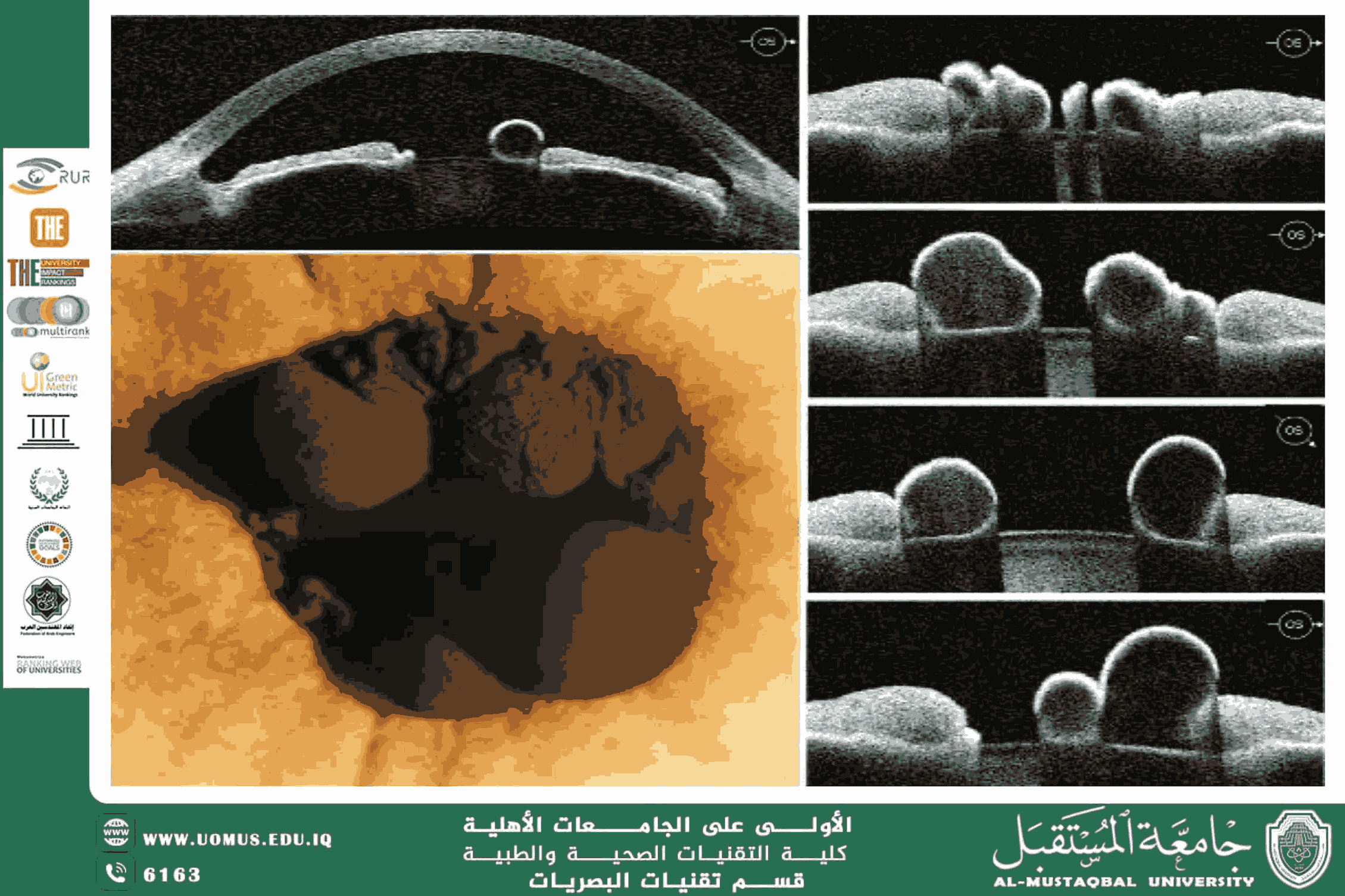 مقالة علمية للتدريسي م.م حسن قحطان كاظم الحسين  (التصوير المقطعي للعين: نافذة مبكرة للكشف عن أمراض الجس)