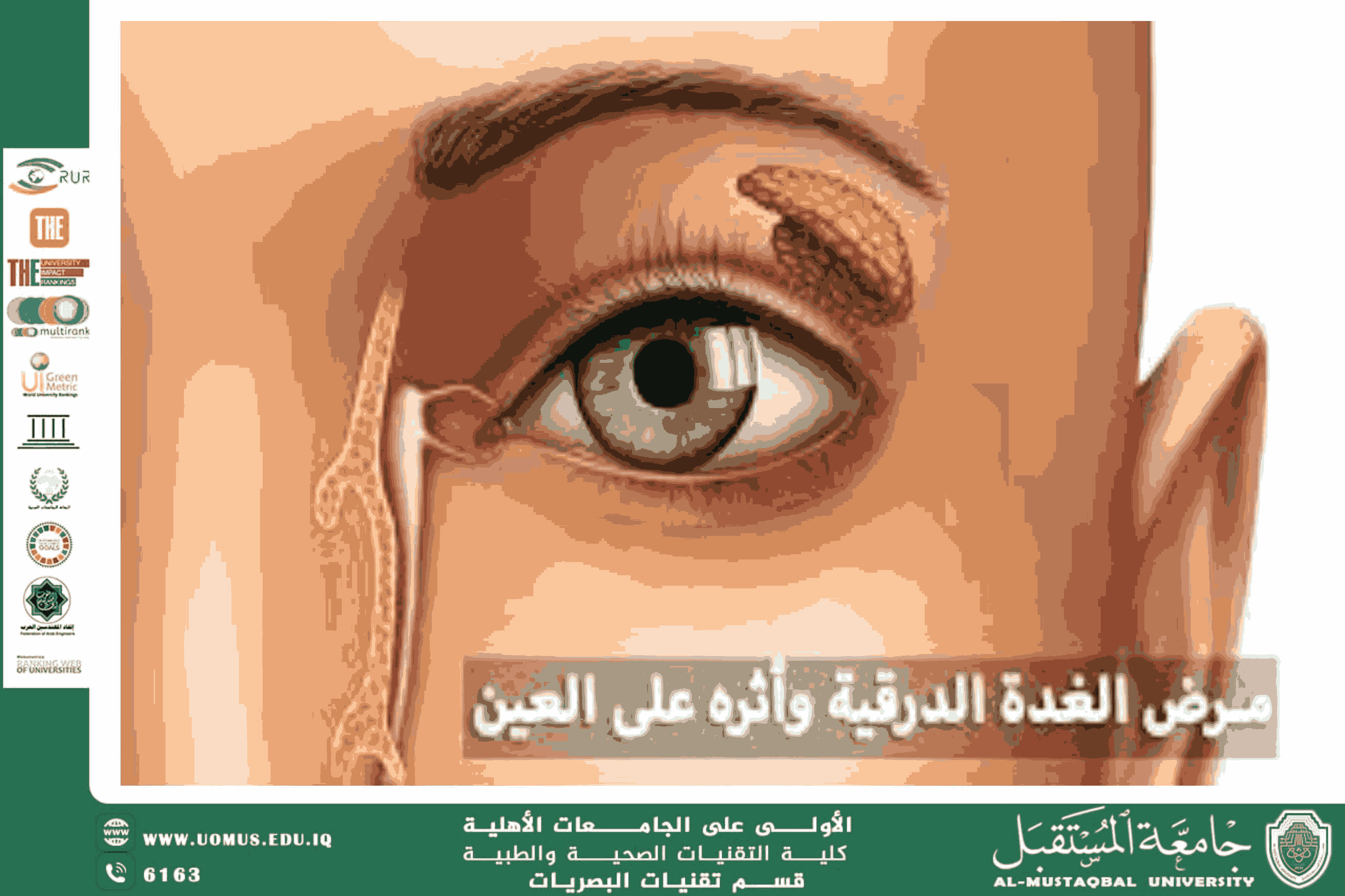 مقالة علمية للتدريسي م.م. مهيمن سمير عارف (العلاقة بين أمراض الغدة الدرقية واضطرابات العين: منظور بصري إكلينيكي)