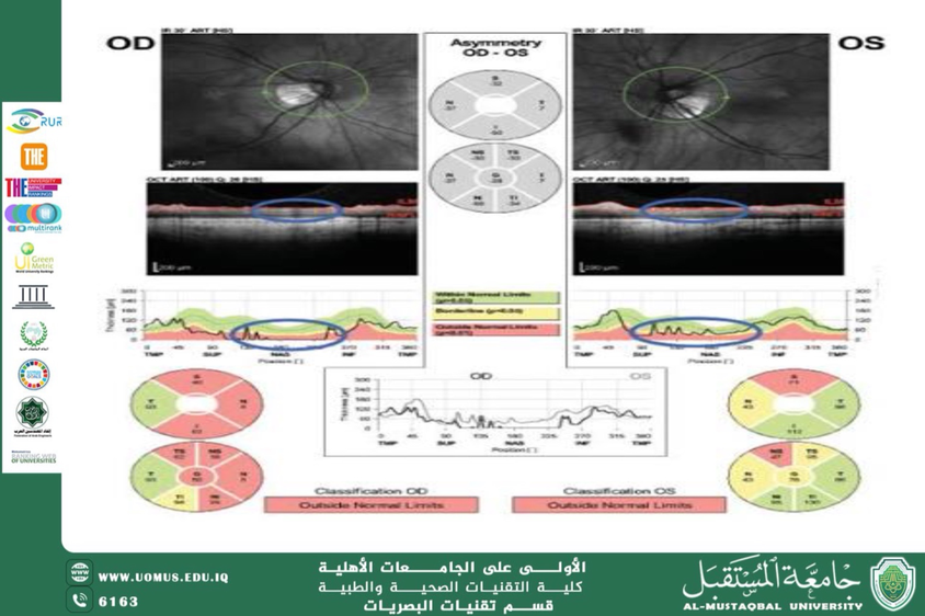 مقالة علمية للتدريسي مهيمن سمير عارف بعنوان (دور التصوير المقطعي البصري التوافقي (OCT) في الكشف المبكر عن الجلوكوما)