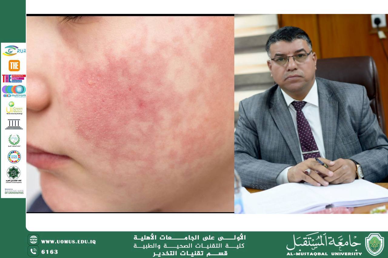 Rubella (German Measles)