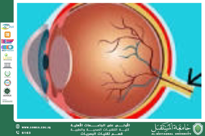 مقالة علمية للكاتب حسن عبد علي بعنوان (العلاج البصري (Vision Therapy) ودوره في معالجة الحول والعين الكسولة عند الأطفال)