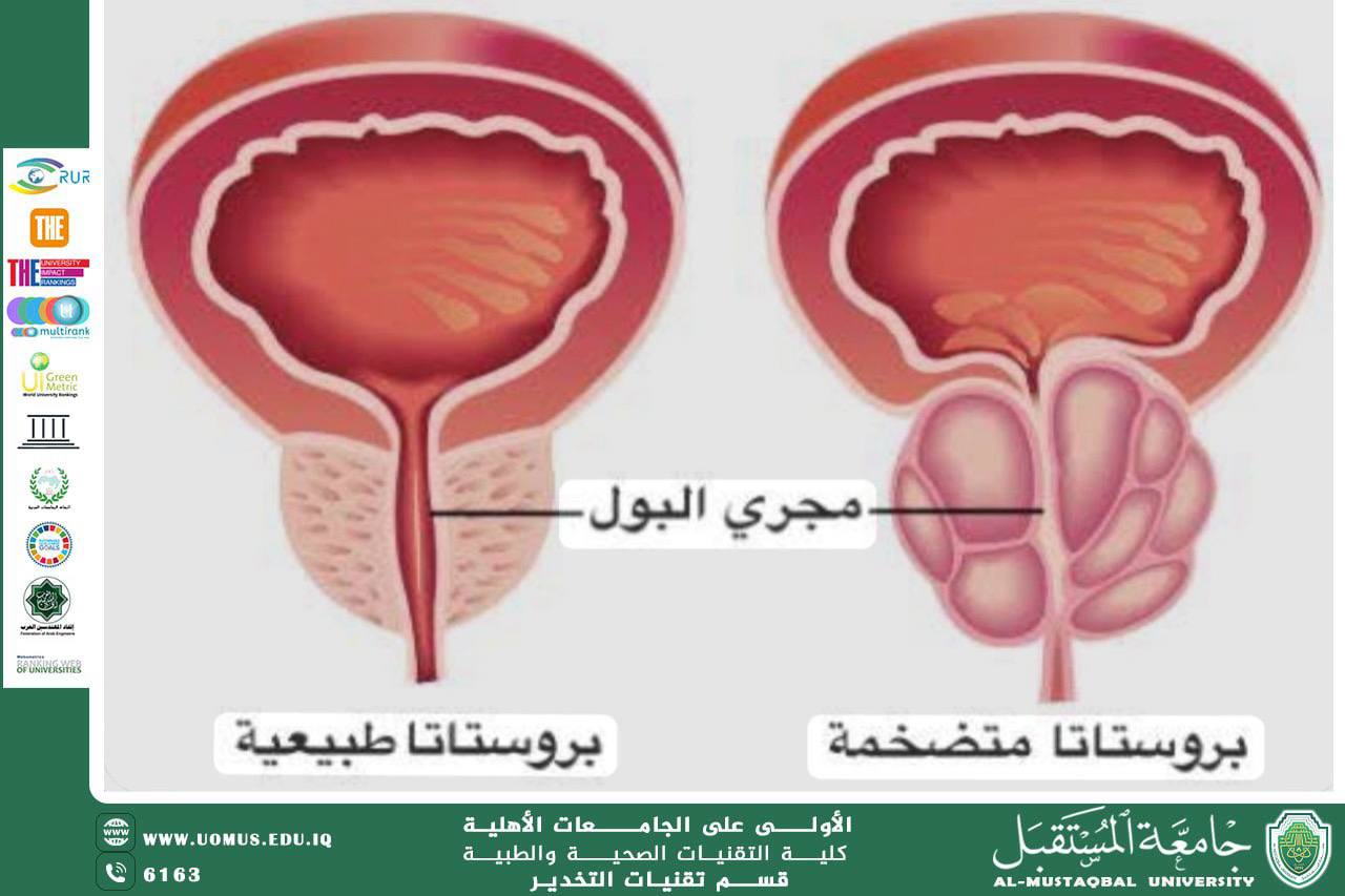 Benign Prostatic Hyperplasia (BPH)