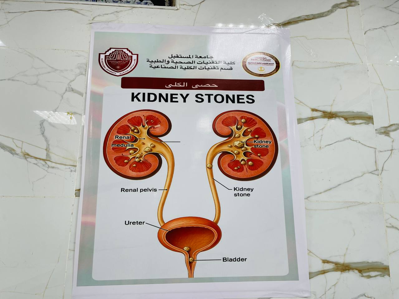 بوستر عن حصى الكلى 