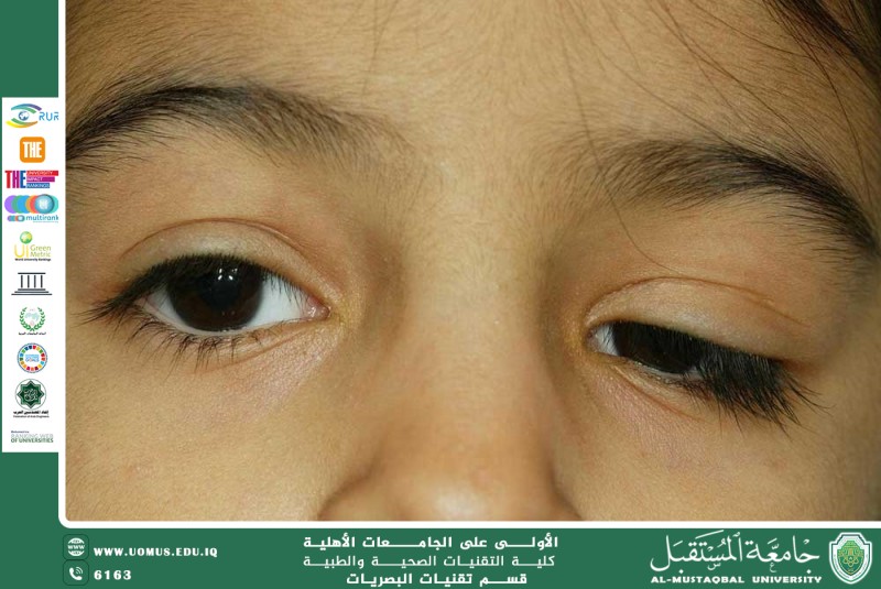 تدلي الجفون المكتسب عند الاطفال والبالغين