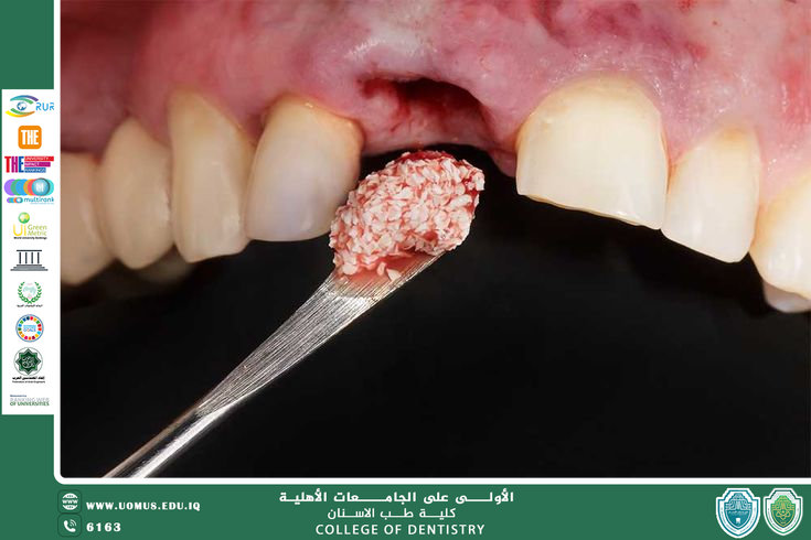 Preprosthetic Surgery