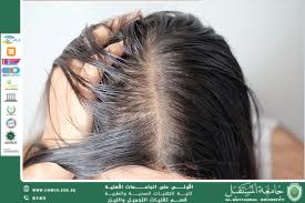 Genetic Hair Loss: Causes and Treatment Options