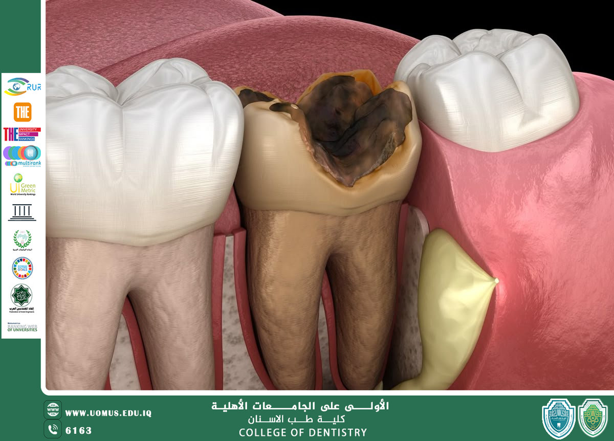 تسوس الأسنان: الأسباب، المظاهر السريرية وطرق الوقاية