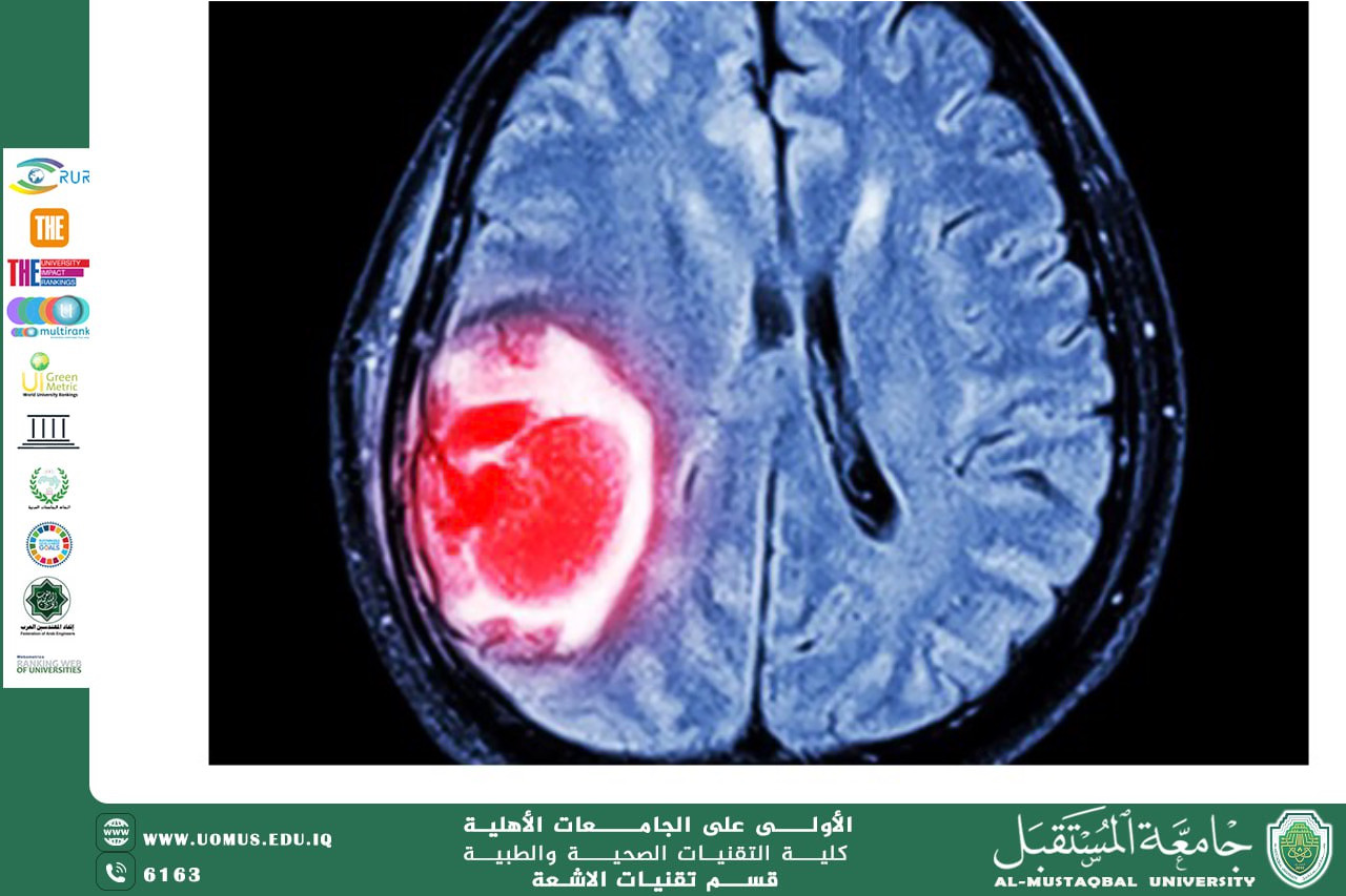دور الذكاء الاصطناعي في دقة التشخيص باستخدام الرنين المغناطيسي لأورام الدماغ