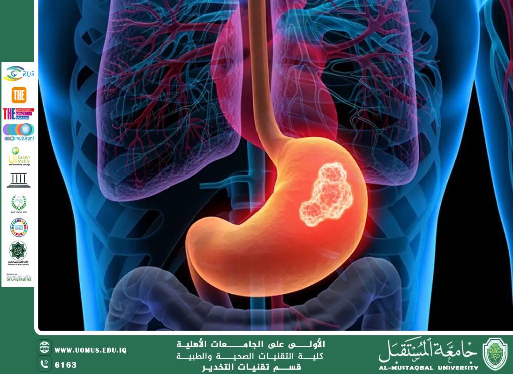 Helicobacter pylori: The Spiral Bacterium and Its Impact on Gastrointestinal Health