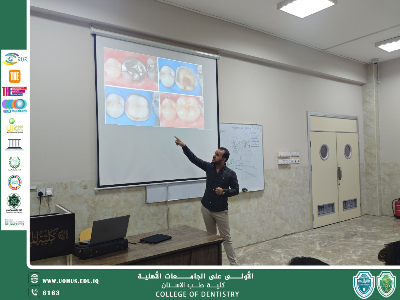 كلية طب الأسنان تقيم ورشة علمية بعنوان Posterior Indirect Adhesive Restoration
