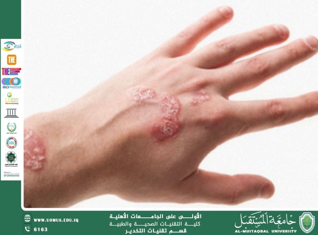 مقالة علمية للاستاذة ياسمين مؤيد عن الإكزيما