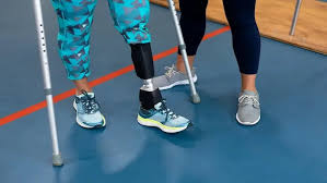 he Development of Prosthetic Limbs and Their Role in Achieving the Sustainable Development Goals