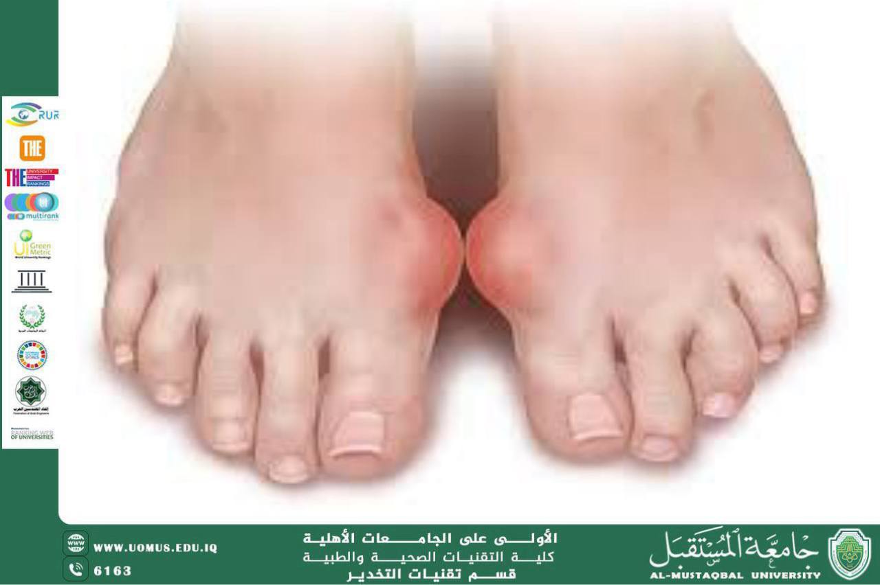 Kings’ Disease (Gout)