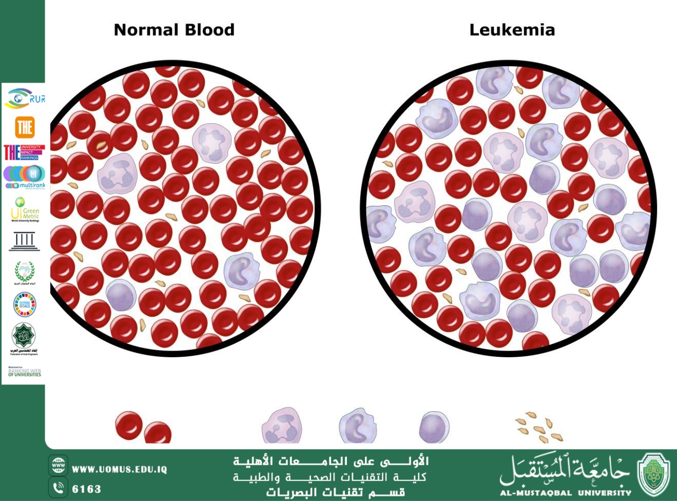 مقاله علمية للست تمارا نهاد عباس بعنوان (سرطان الدم (اللوكيميا)