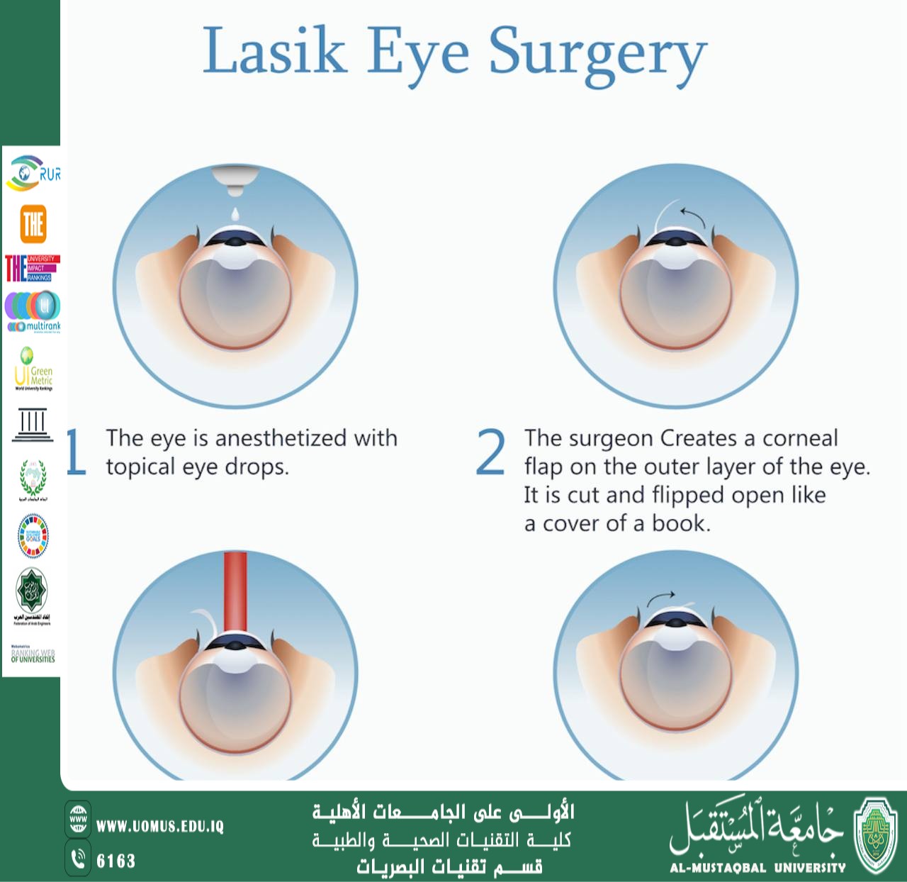 مقاله علمية للتدريسي حمزه نادر بعنوان الاكسايمر ليزر في طب العيون